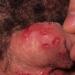 التهاب القلفة و الحشفة عند الرجال ، الأعراض الأولى وطرق العلاج أعراض التهاب القلفة و الحشفة
